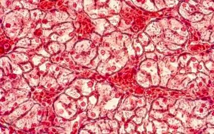 може бути necrobiosis