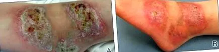 necrobiosis lipoidica