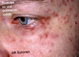 kálium-jodid dermatológiai dermnet