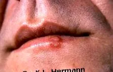 herpes