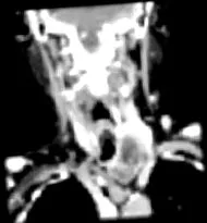 euthyreoid euthyreoid