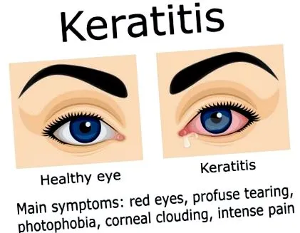 кератиту кератиту