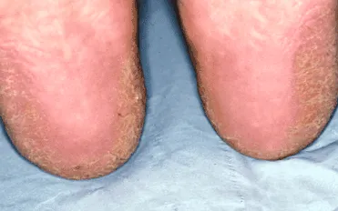 Jean Watkins keratoderma