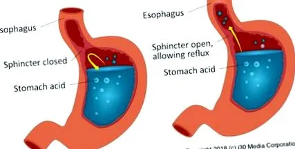 reflux diétás