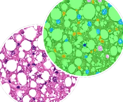 alkoholmentes steatohepatitis által kiváltott
