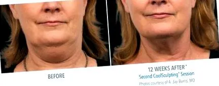 посібник coolsculpting