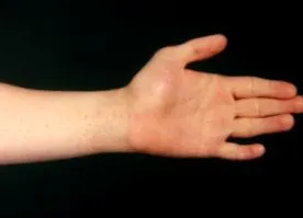 nitidus