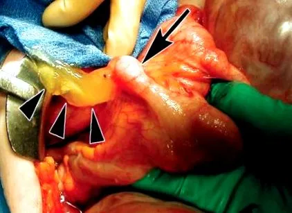 cystadenoma mucinous cystadenoma