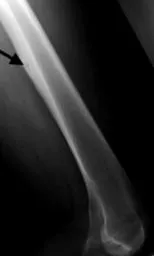 osteoma osteoid