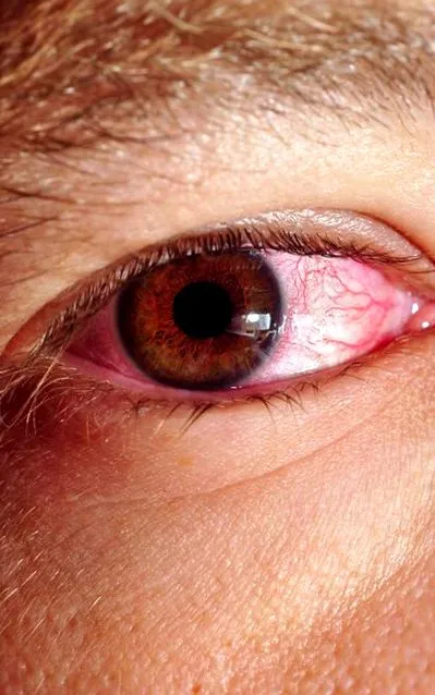pinkeye