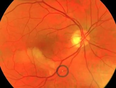 retina artéria retina artéria