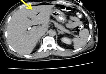 choledochoduodenostomia