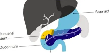 stent