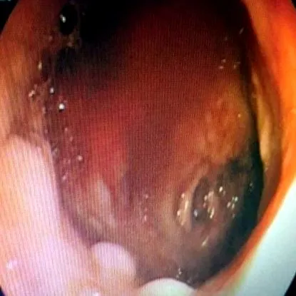 gastritis gastritis