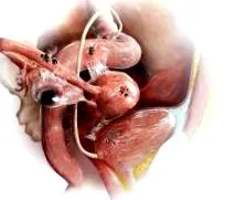 endometriózis fájdalom