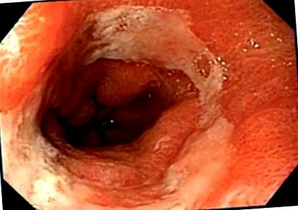 reflux reflux