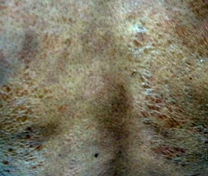 ichthyosiform