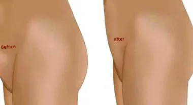 reduction pubic