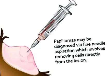papilloma