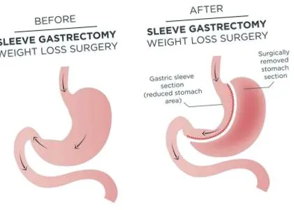 Bariatric Surgery Bariatric Surgery