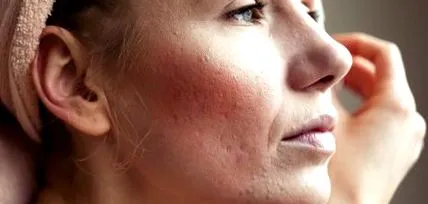 розацеа