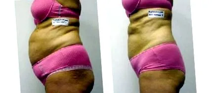 I-Lipo® invazív nincs nincs