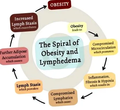 elhízás okozta lymphedema