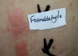 allergia formaldehid expozíció