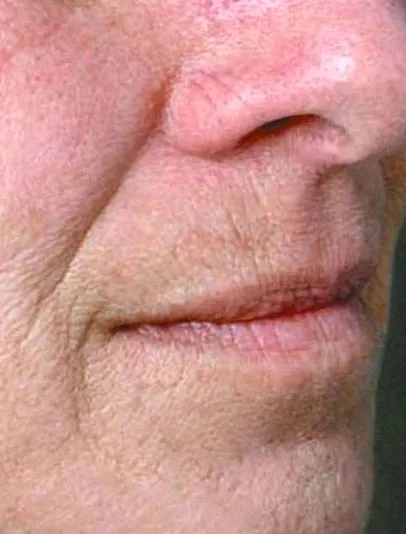 juvéderm