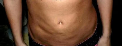 lipo dudorok
