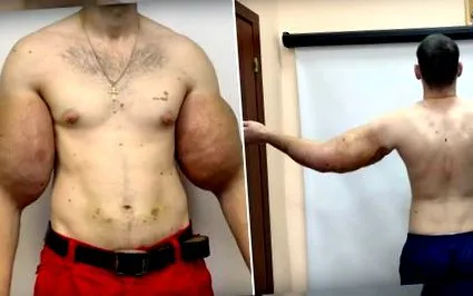 біцепса