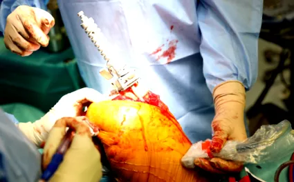 megtartott intraoperatív