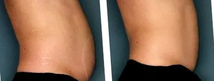ultrashape