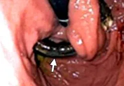 lapband