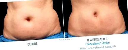 coolsculpting coolsculpting