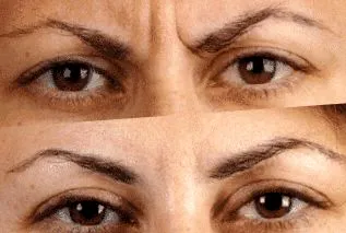 juvederm