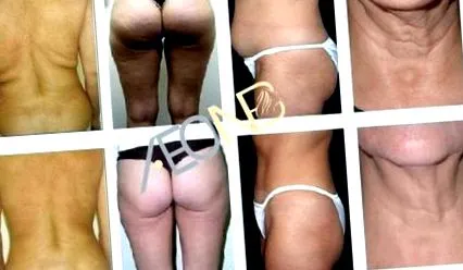 ultrahang