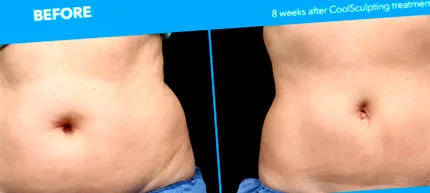 coolsculpting вільну
