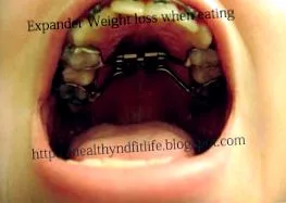 palatal
