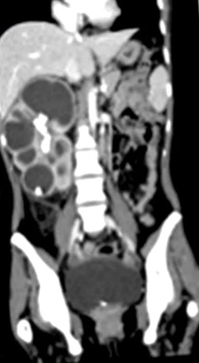 pyelonephritis