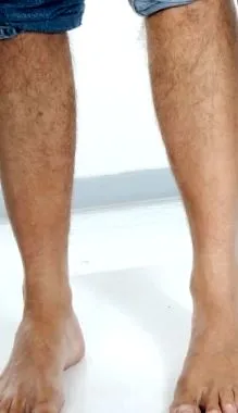 anterolaterális