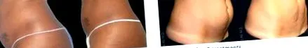 UltraShape eljárás