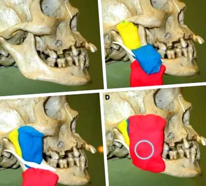 botulinum