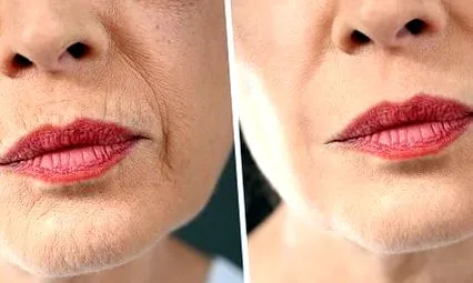botox ajakfeltöltők