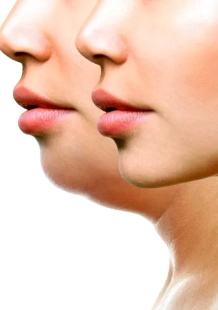 kybella