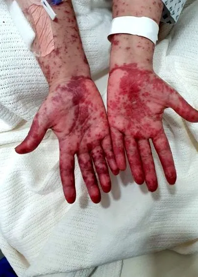 rhupus