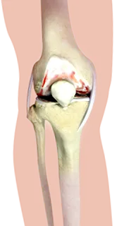 osteoarthritis