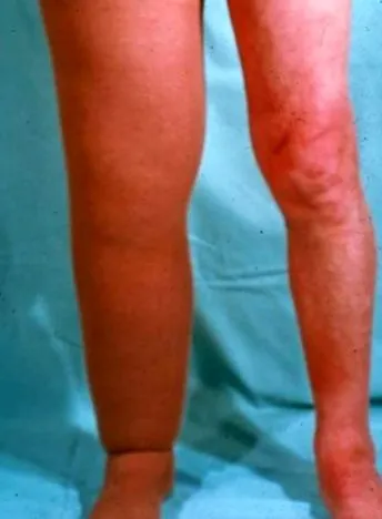 lympha