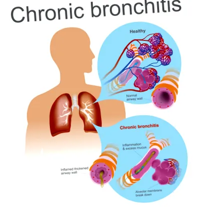 bronchitis