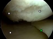 cartilajului articular
